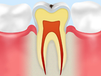 C0 【ごく初期のむし歯】