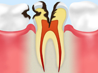 C3 【神経まで達したむし歯】