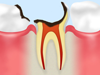 C4 【歯根まで達したむし歯】